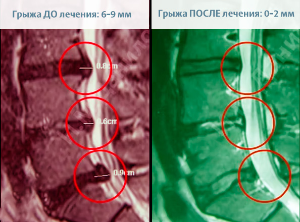 Безоперационное лечение грыжи